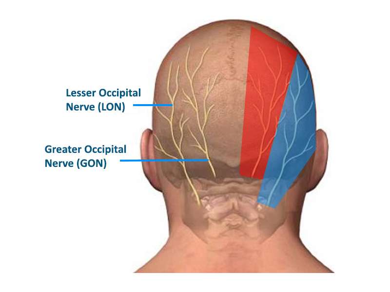 Occipital Neuralgia Symptoms Diagnosis And Treatment