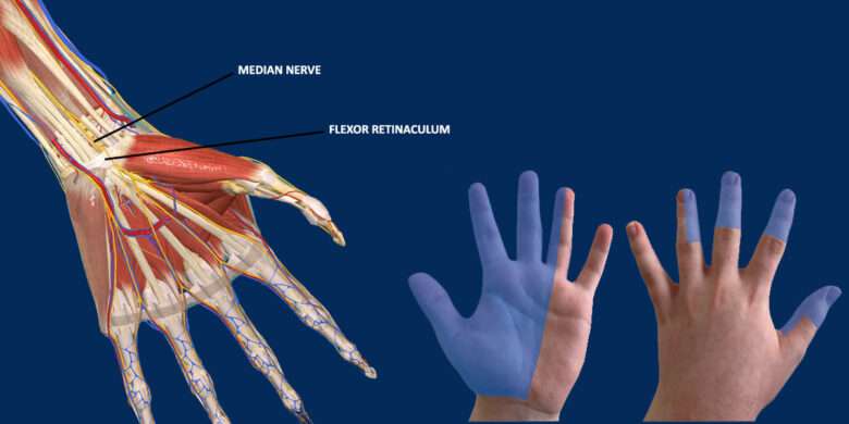 Carpal Tunnel Syndrome - Median Nerve entrapment
