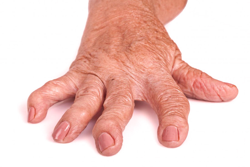 Romatoid artrit