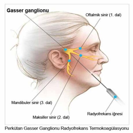 Trigeminal nevralji ve gasser ganglion
