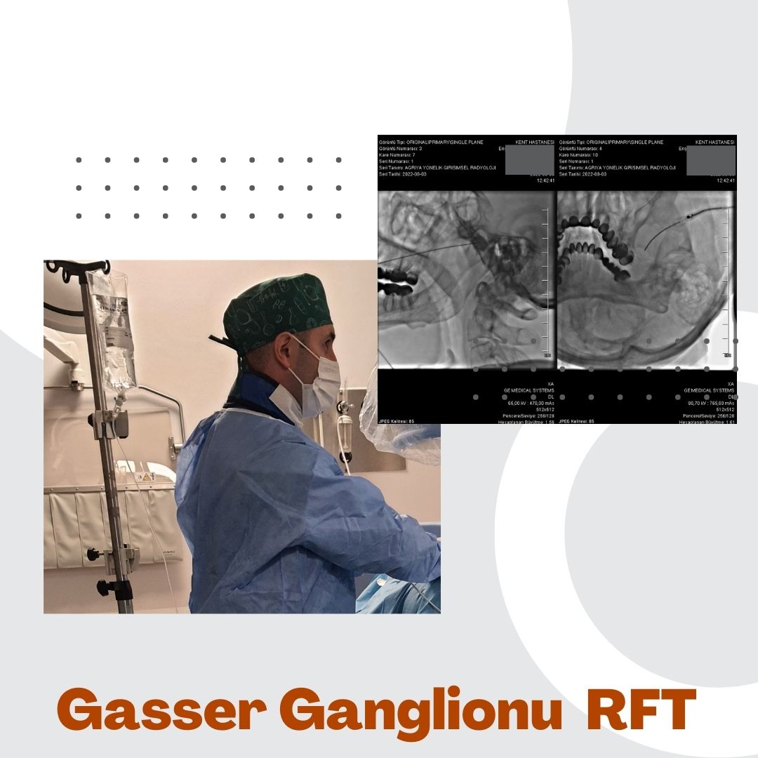 Perkütan Gasser Ganglion Radyofrekans Termokoagülasyonu