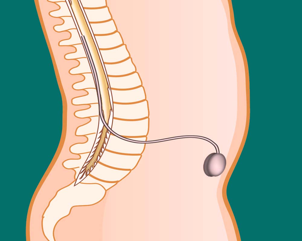intratekal morfin pompası