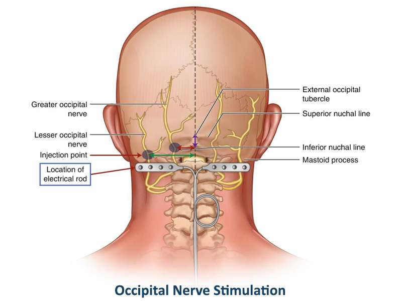 Occipital Neuralgia Symptoms, Diagnosis, and Treatment